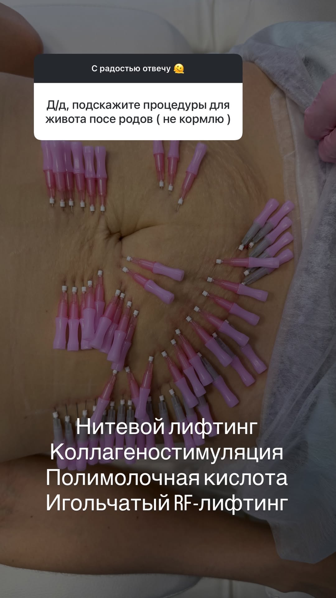 новая фото в сторис @tvoy.cosmetolog_ 16.01.2026