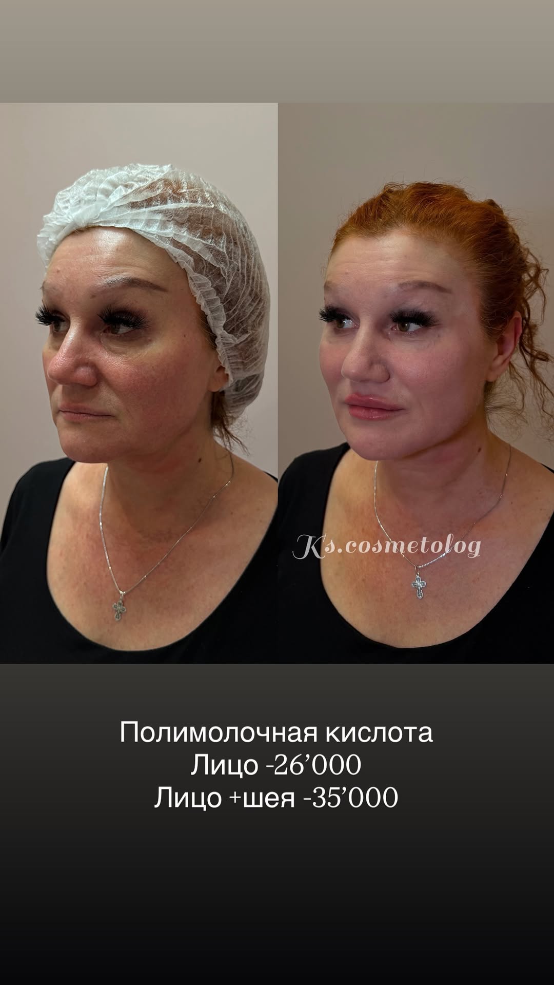 новая фото в сторис @ks.cosmetolog 18.02.2026