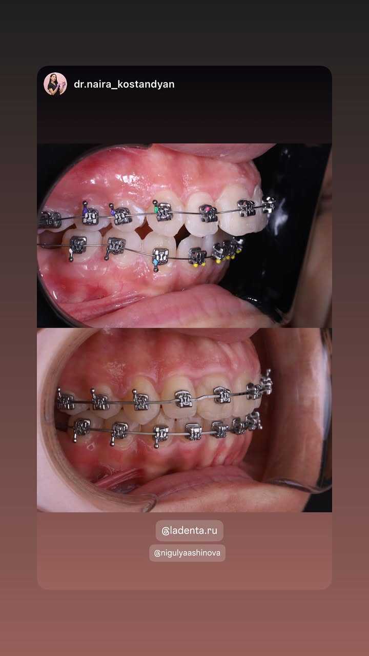 новая фото в сторис @nigulyaashinova 26.02.2026