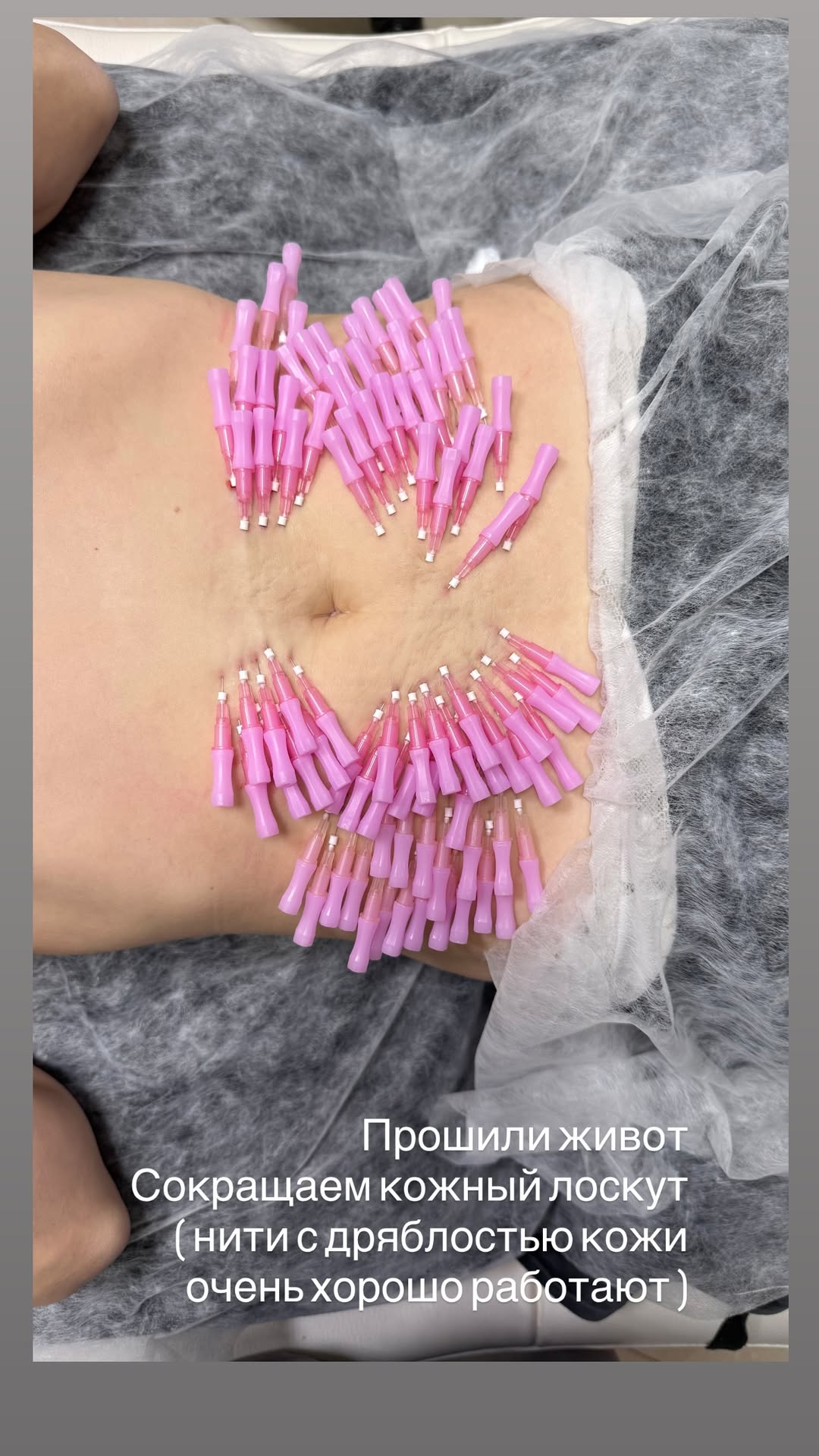 новая фото в сторис @tvoy.cosmetolog_ 06.03.2026