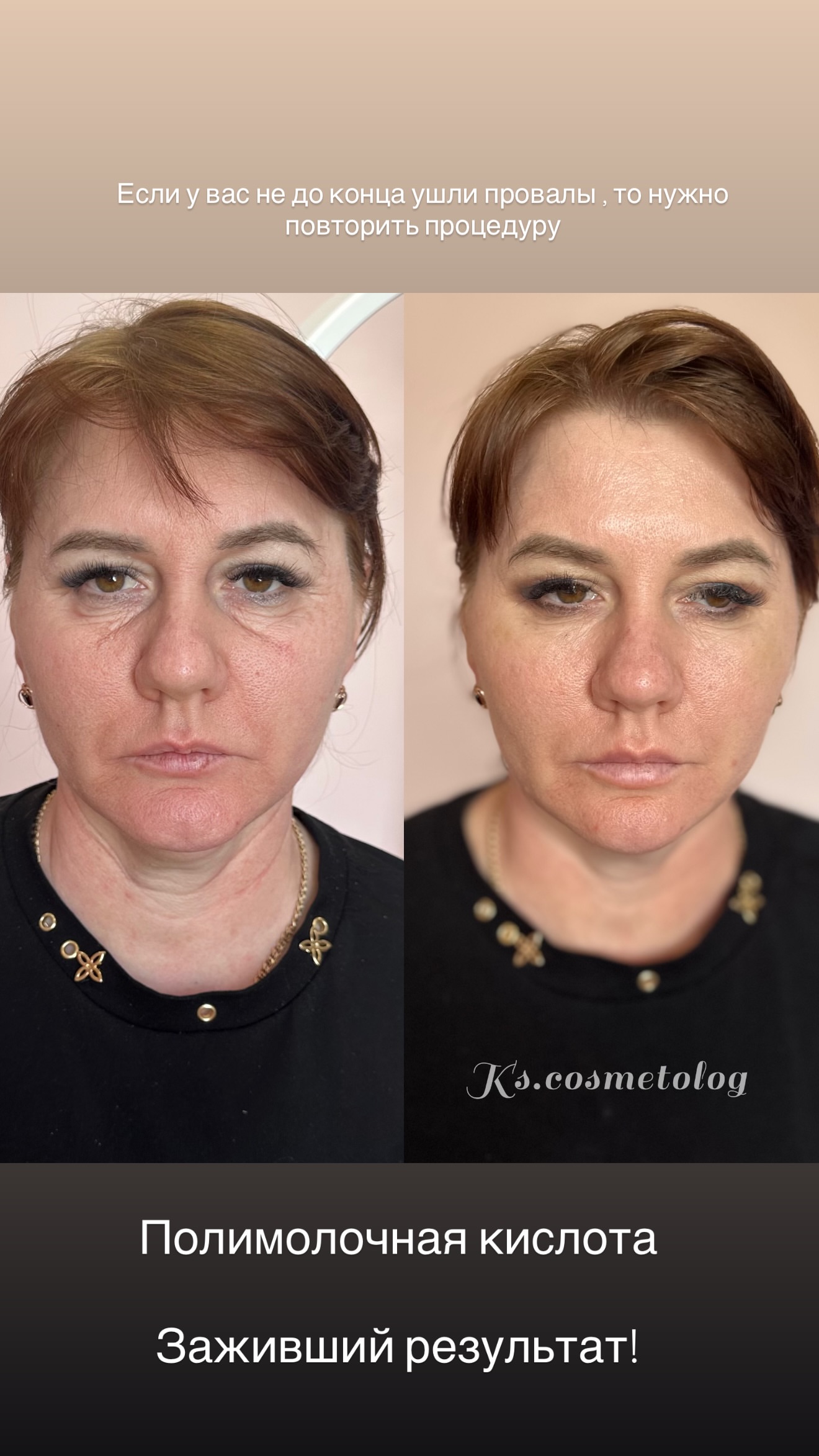 новая фото в сторис @ks.cosmetolog 24.04.2026
